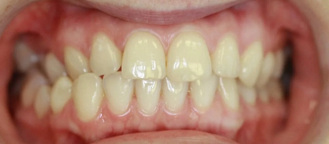 Ортодонтическое лечение на системе StarSmile